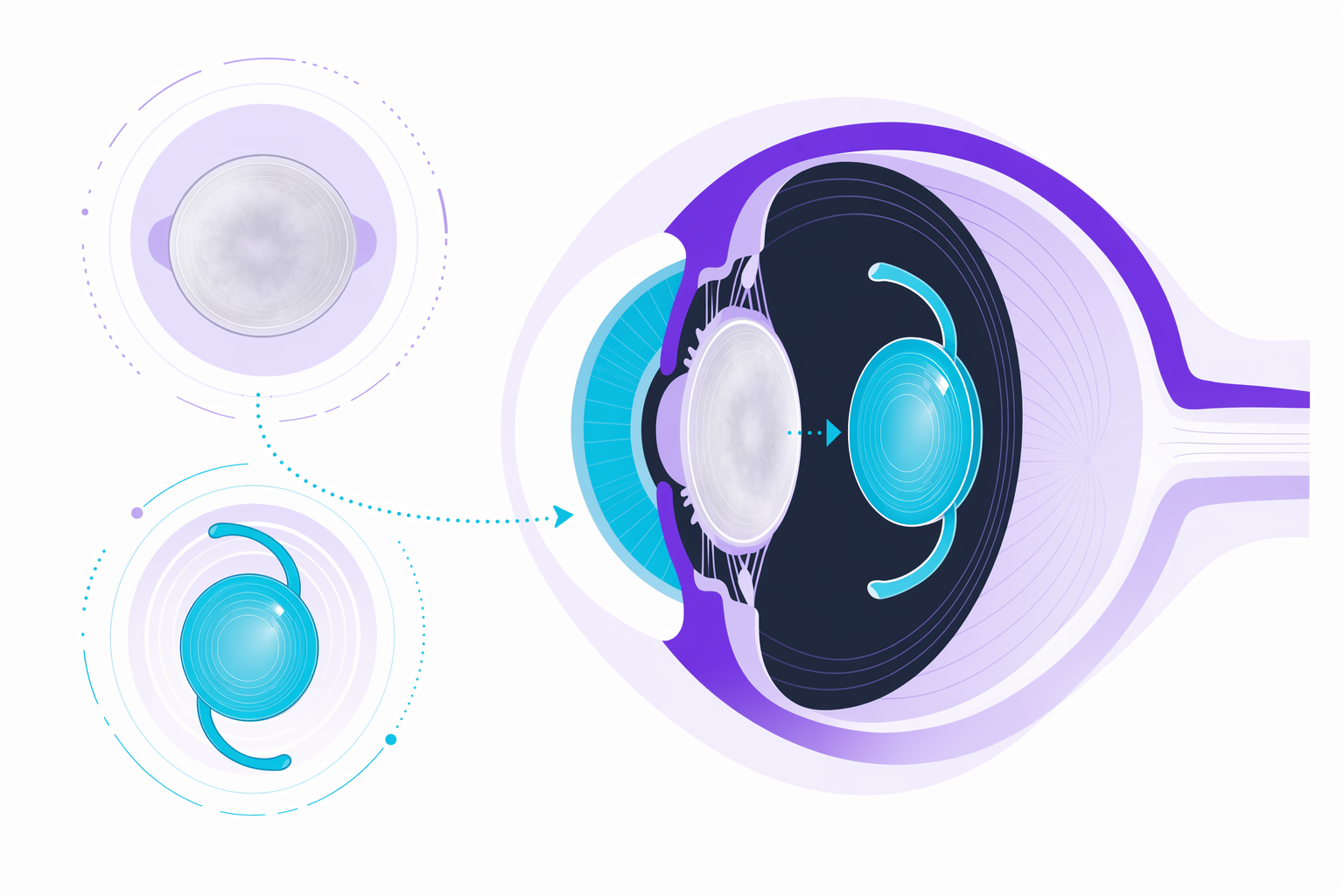 Illustration for Cataract & lens surgery