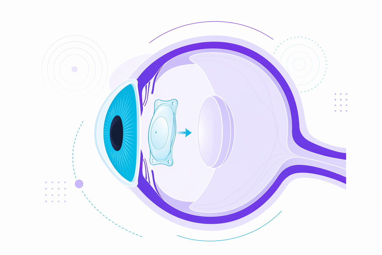 Illustration for ICL (implantable lens)