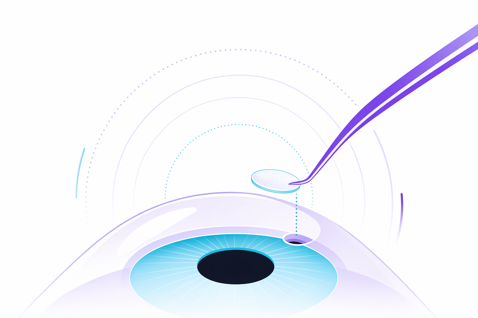 Illustration for SMILE eye surgery